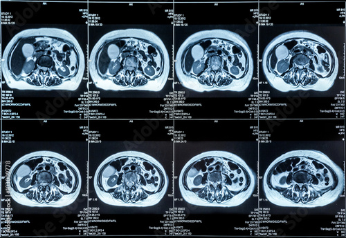 MRI of the Abdomen organs