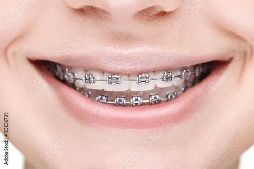 Broad smile girl with metal braces. Closeup