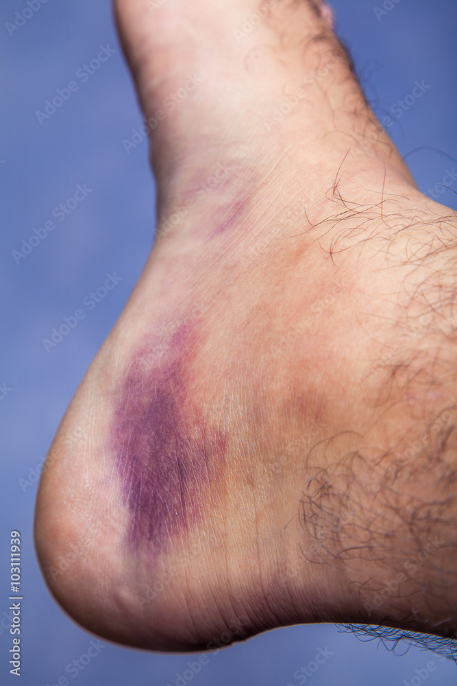 Bruised ankle after tripping over and twisting on right hairy foot on blue background.
Bruised ankle after tripping over and twisting on right hairy foot on blue background.