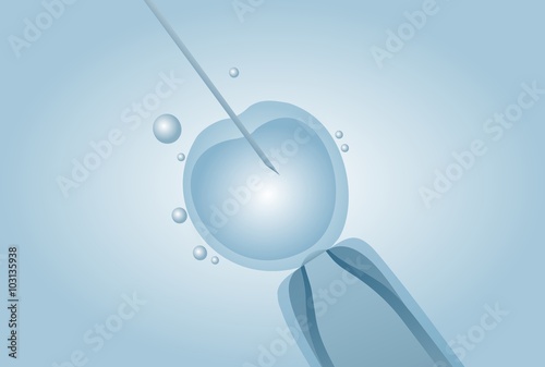 Microscopic artificial insemination, In vitro fertilisation IVF