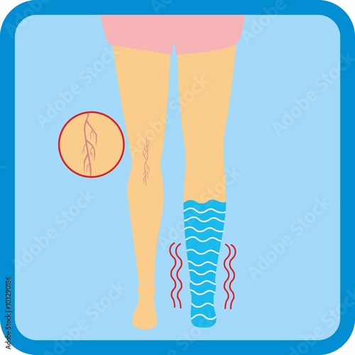 illustration legs with vascular net legs with edema. adverse pregnancy symptoms