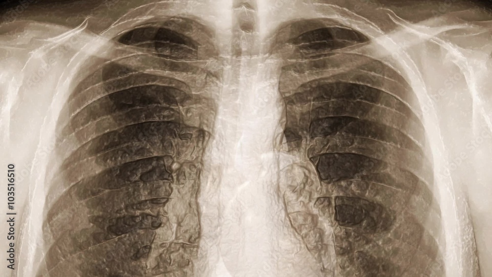 X-ray of chest covered with transparent skin. (loop ready file) Stock ...