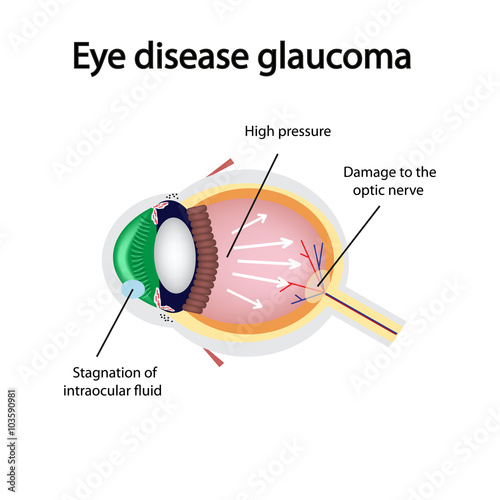Glaucomatous eye. Violations causing glaucoma