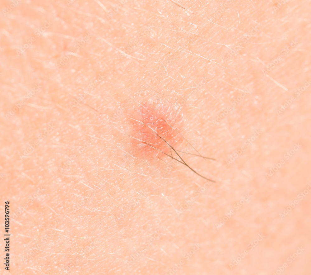 Fototapeta premium mole on the skin
