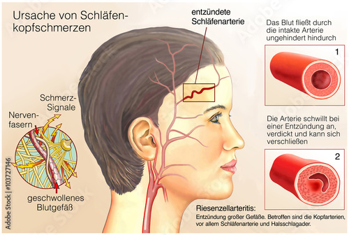 Gefäß-Rheuma.Schläfenkopfschmerzen photo