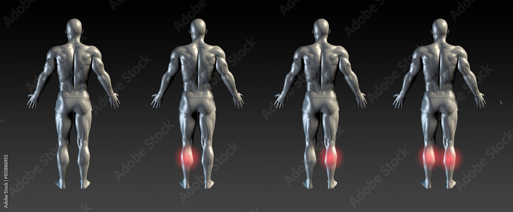 Calf Injury Calf Injury