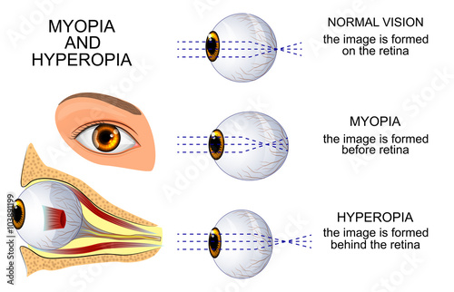 myopia and hyperopia photo