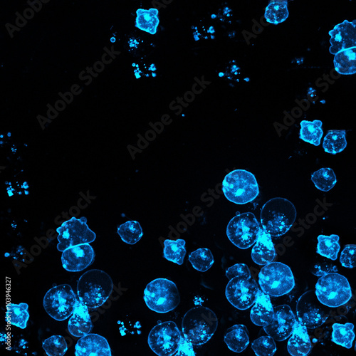 Leukemic cells labeled with fluorescent molecules