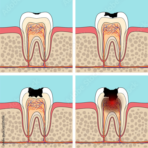 Dental caries stages.