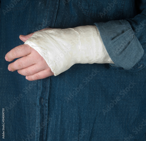 Fractured hand in a gypsum plaster
