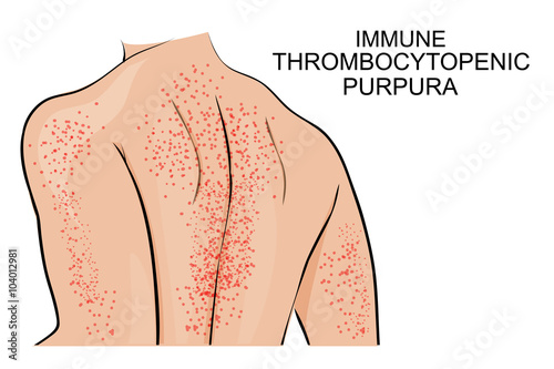 the skin lesions in immune thrombocytopenic purpura photo
