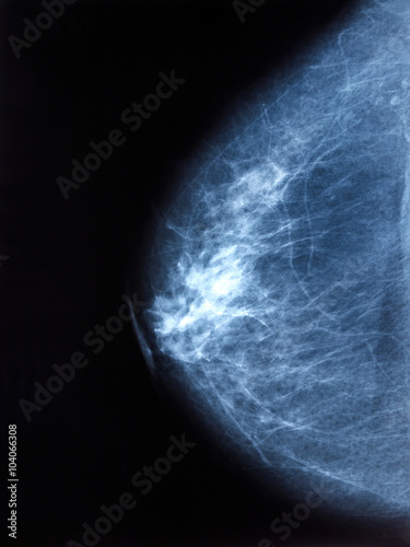 X-ray image of breast mammogram woman