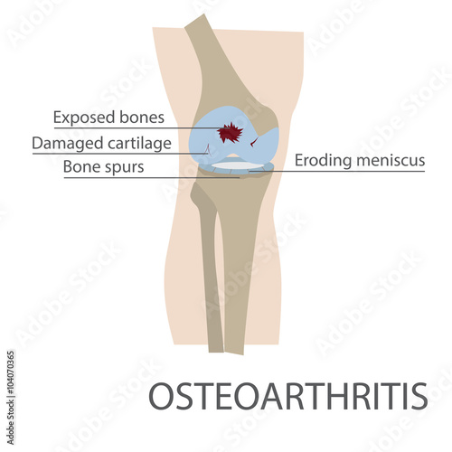 osteoarthritis human knee joint disease. vector format illustration
