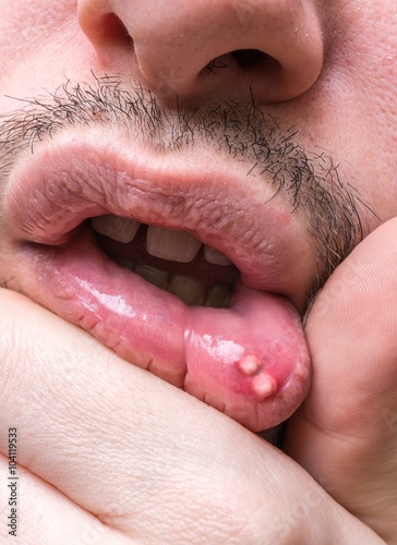 Painful aphtha ulcer on man's mouth. photo