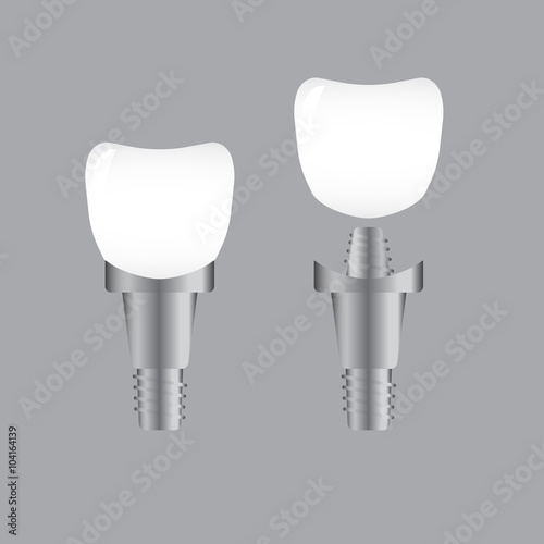 Tooth implant. Implant dental and health tooth