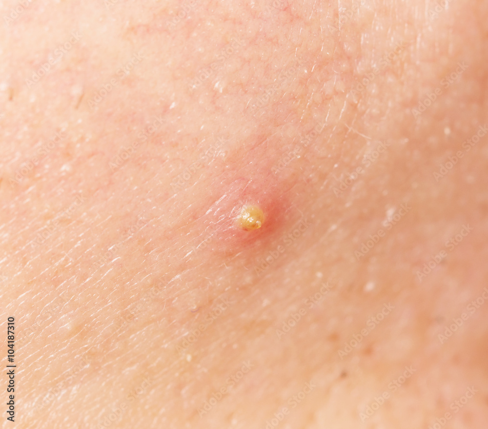 Acne skin Acne skin