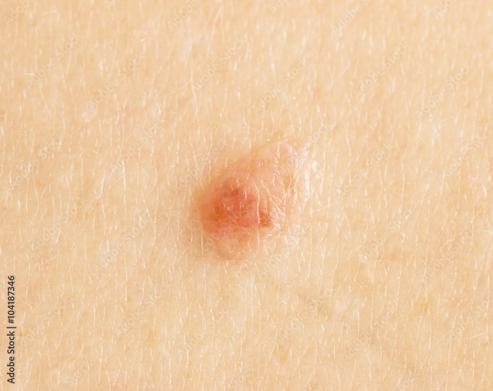mole on the skin foto de Stock | Adobe Stock