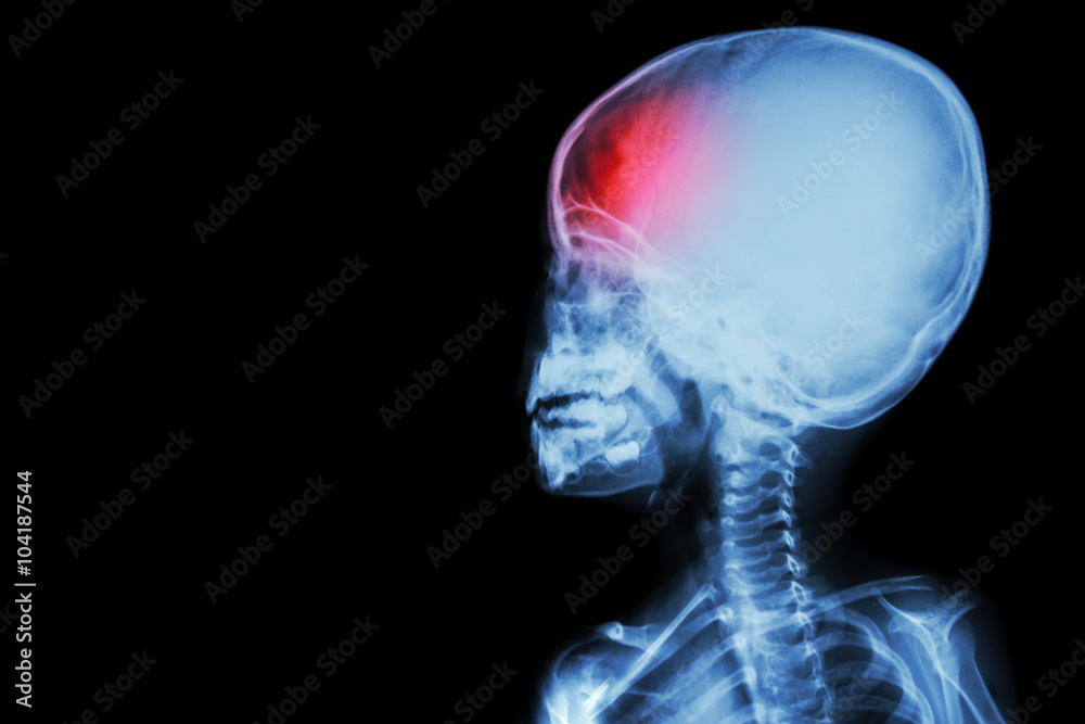 film x-ray body of child and headache ( brain disease ) ( isolated )
