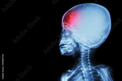 film x-ray body of child and headache ( brain disease ) ( isolated )