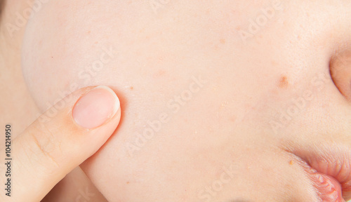 Young girl with problem skin