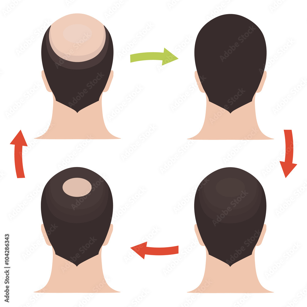 Hair loss stages set. Rear view of a man losing hair before and after hair  treatment and hair transplantation. Implantation of hair. Male hair loss  pattern. Alopecia. Hair growth. Vector illustration. Stock