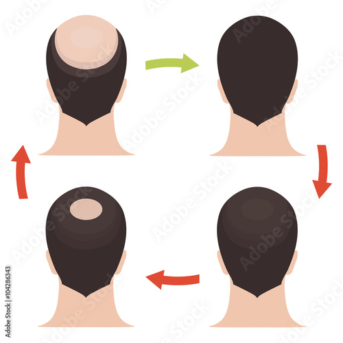 Hair loss stages set. Rear view of a man losing hair before and after hair treatment and hair transplantation. Implantation of hair. Male hair loss pattern. Alopecia. Hair growth. Vector illustration.