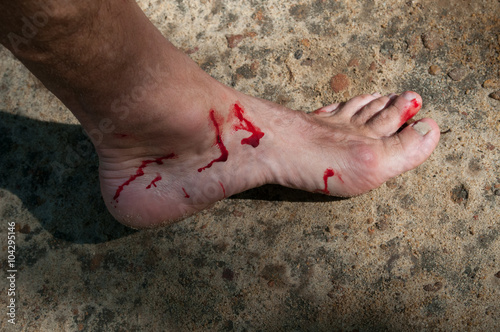 Man's bloody foot