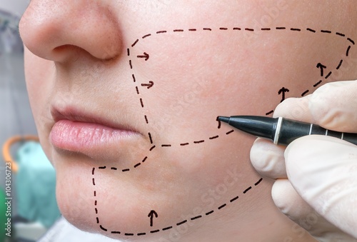 Facial plastic surgery. Hand is drawing lines with marker on cheek