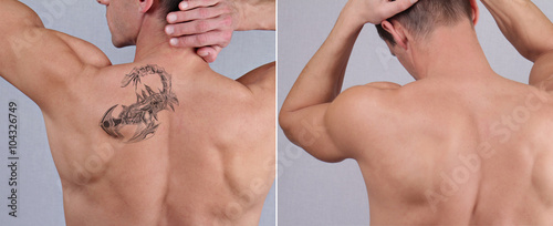 Laser tattoo removal before and after. Attractive Man with tattoo on his back skin