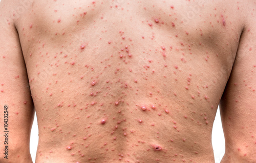 Back side of a man who having varicella blister or chickenpox ,isolated on white