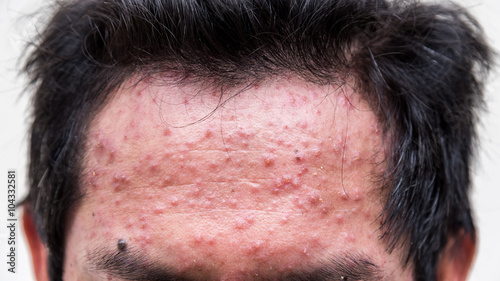 Fotografie forehead of a man who having varicella blister or chickenpox ,isolated on white