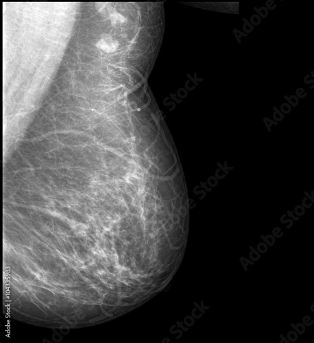 X-ray: Breast Cancer (Mamary tumor) photo