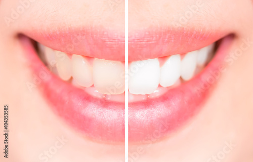 Close-up teeth female between before and after brush the teeth,