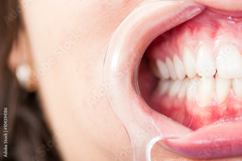 Tableau sur toile Close-up of half mouth with plastic retractor and teeth