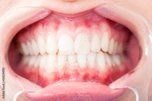 Bilde på lerret Close up of woman cavity protected by retractor