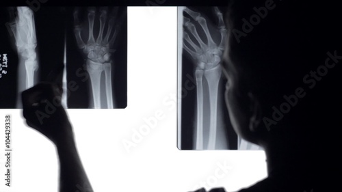 Doctor analyse x rays broken bones. Doctor looking at x-rays of broken wrist in illuminated panel.