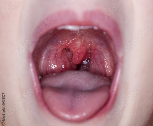 throat tonsil photo