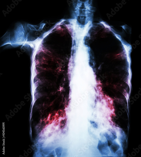 Pulmonary Tuberculosis  ( film chest x-ray :  interstitial infiltrate both lung due to Mycobacterium tuberculosis infection ) photo