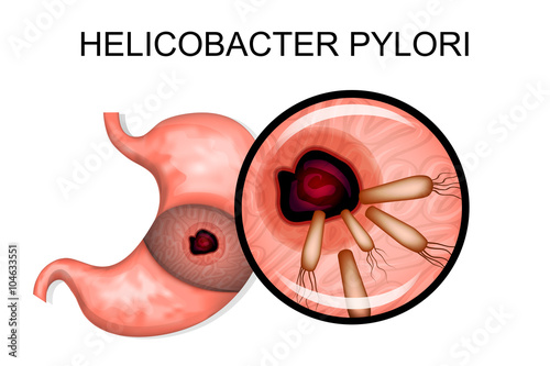 pathology of the stomach. Helicobacter pylori photo
