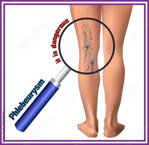 Phlebeurysm. Varicose veins. Medicine. Diseases of the man.