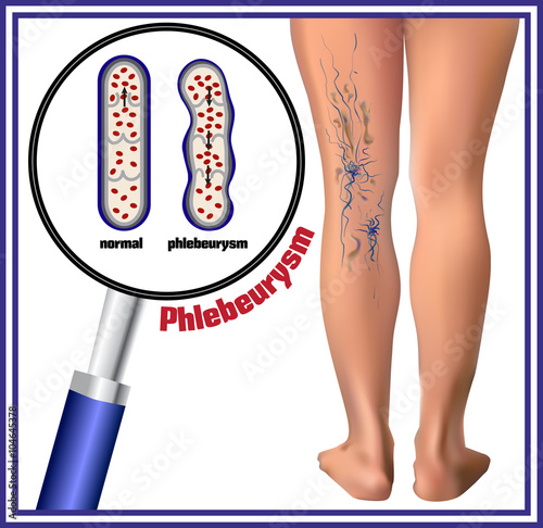 Phlebeurysm. Varicose veins. Medicine. Diseases of the man.