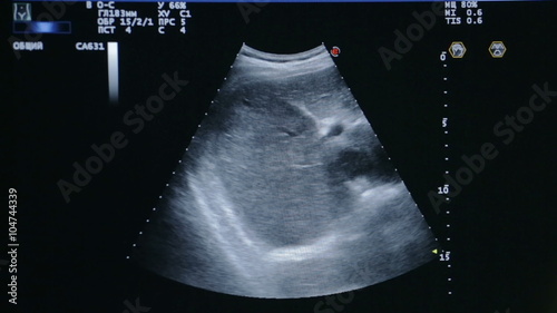 Screen of ultrasound examination of the abdomen. Medical specialist analysing woman abdomen using ultrasound machine.