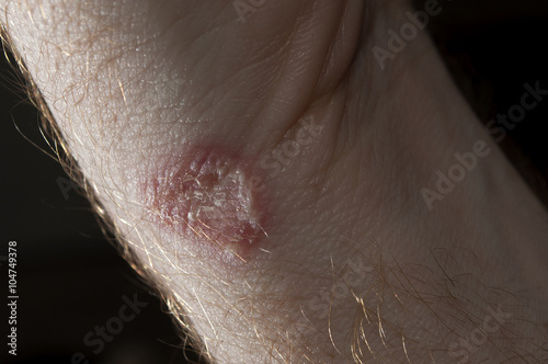 Ringworm on white man / Mycosis