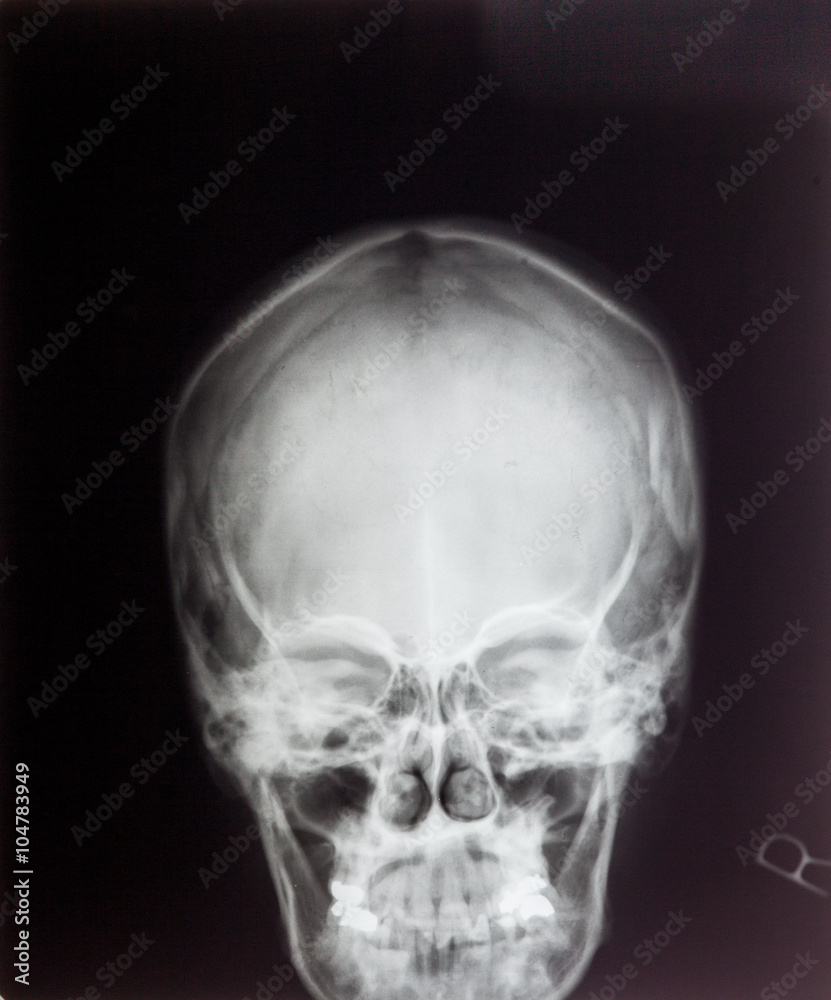 X ray MRI - Image of Spinal Column Neck pain and Skull Head Stre X ray MRI - Image of Spinal Column Neck pain and Skull Head Stre