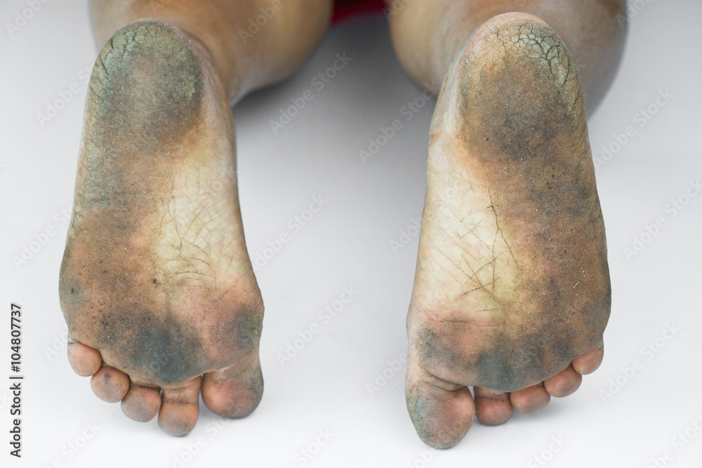 White cracked hotsell feet