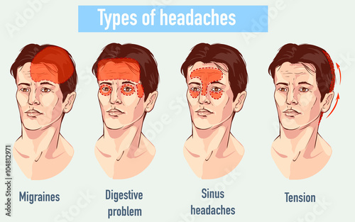 Illustration about headaches 4 type on different area of patient