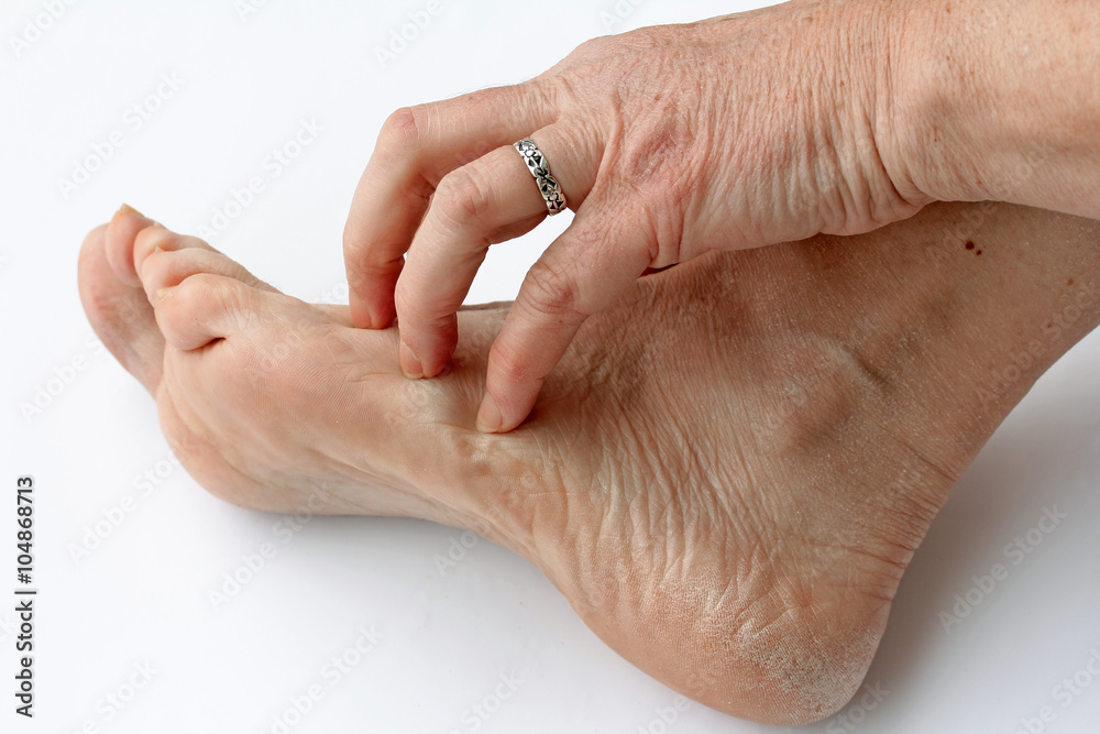 Juckende trockene Haut an den Füßen Stock-Foto | Adobe Stock