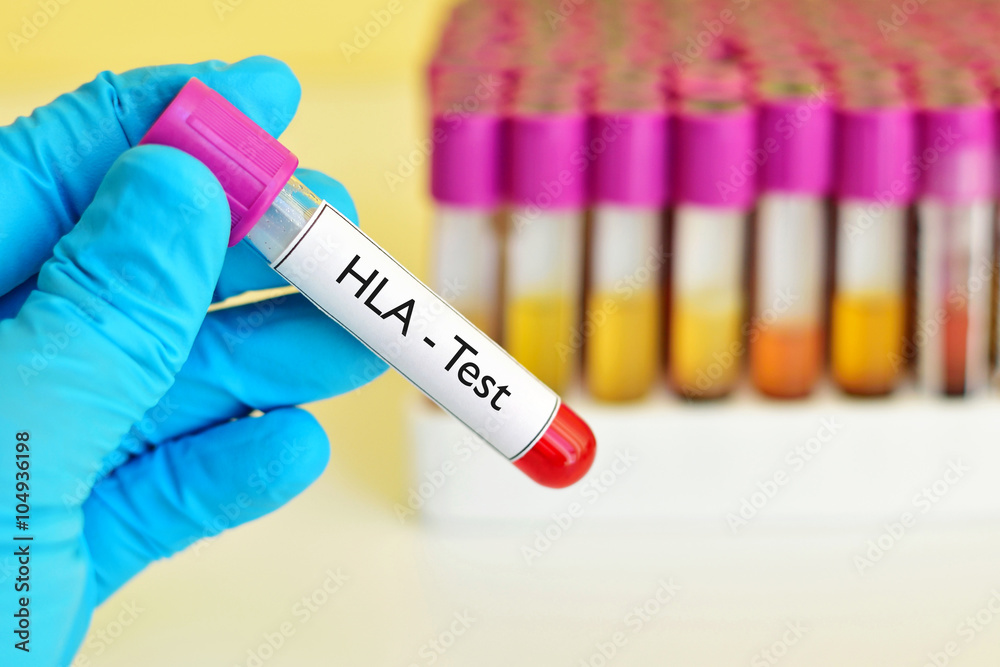 Naklejka premium Blood sample for HLA (Human Leukocyte Antigen) test 