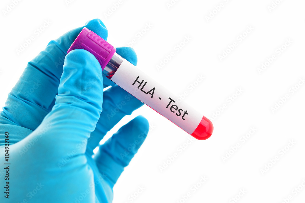 Obraz premium Blood sample for HLA (Human Leukocyte Antigen) test 
