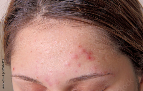 Acne on the girl's forehead